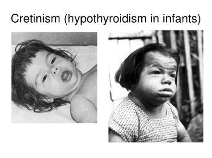 What causes cretinism